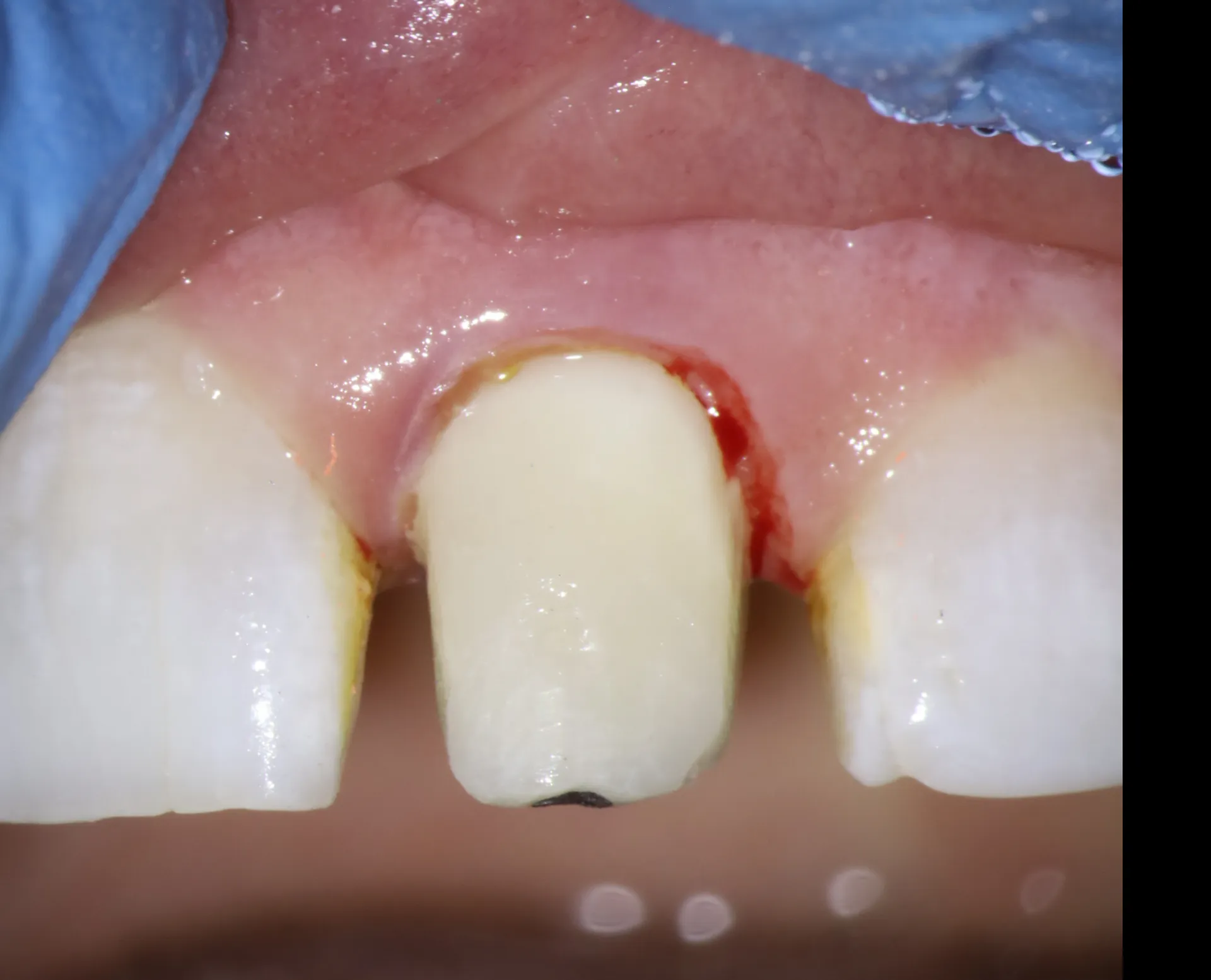 Completed composite buildup restoring coronal structure